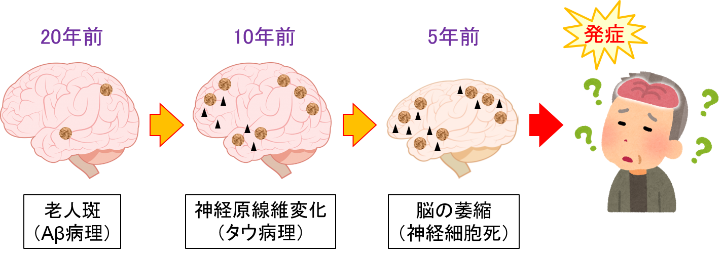 アルツハイマー病: 最初の兆候を特定するには?